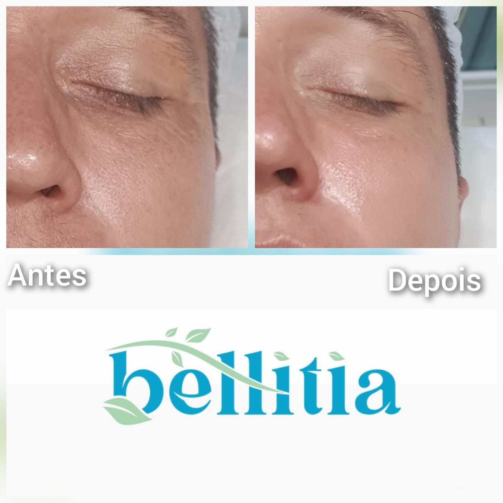 Limpeza de Pele - Antes e Depois