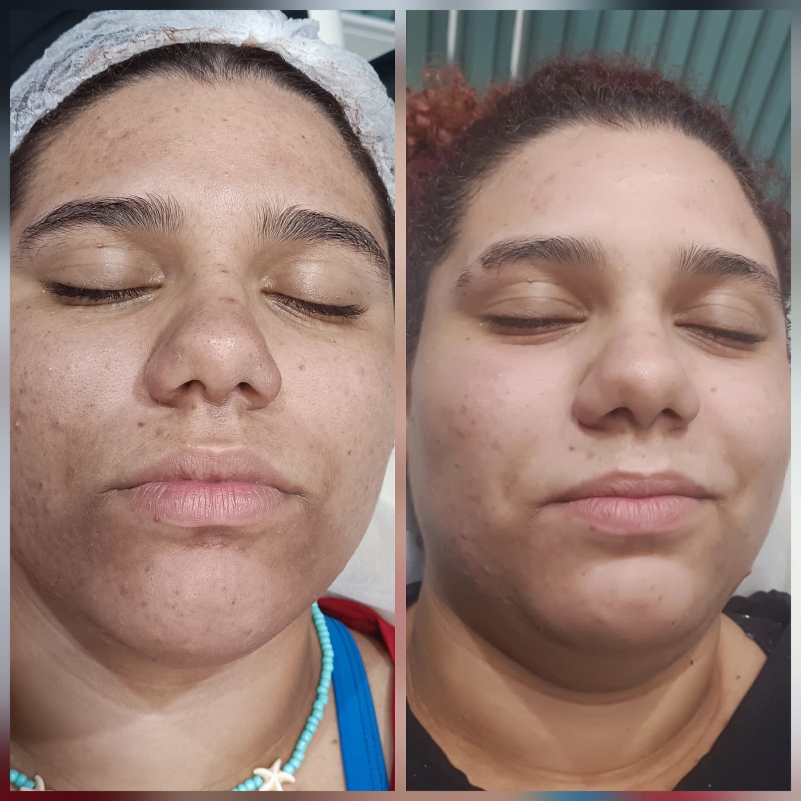 Protocolo antiacne - Antes e Depois