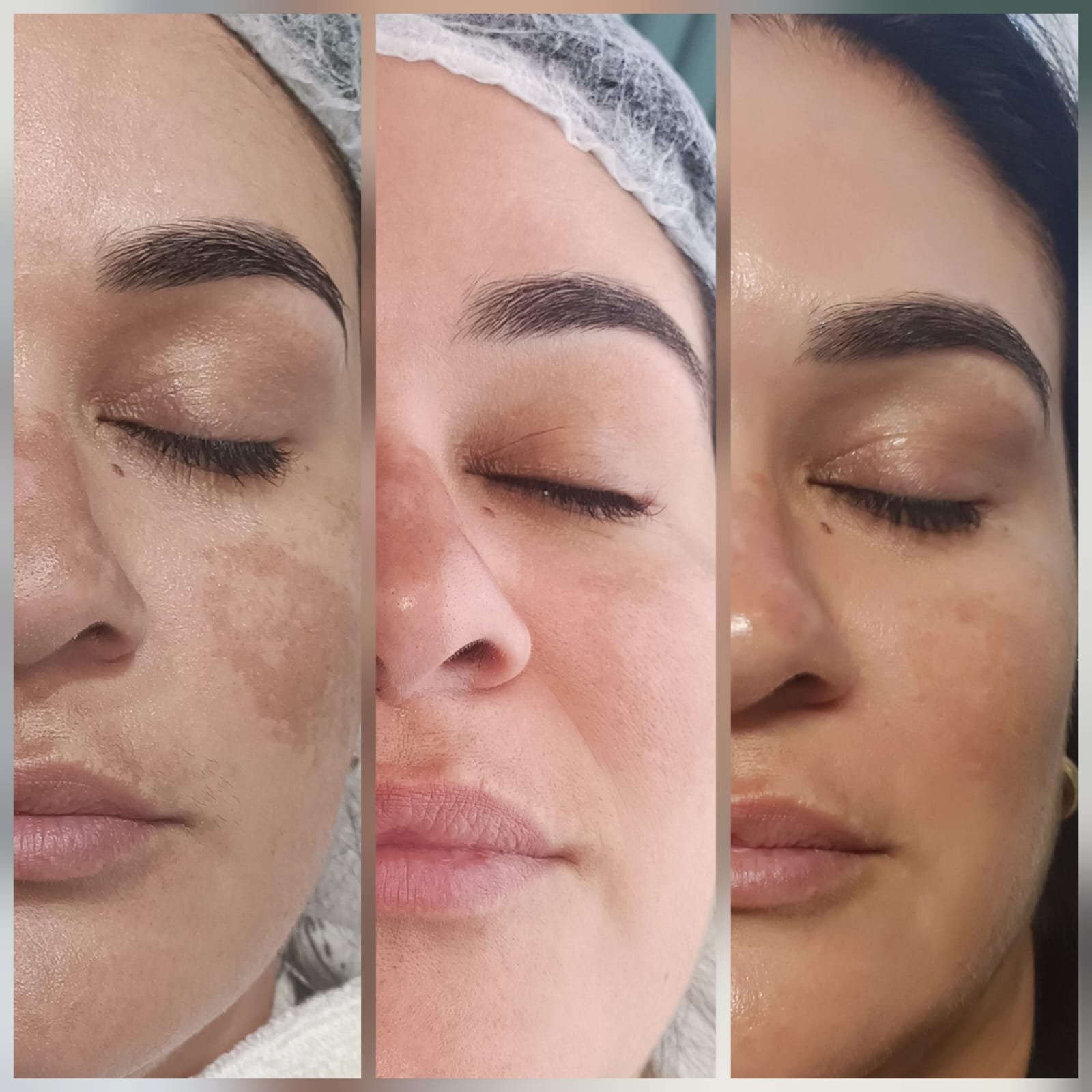 Protocolo melasma - Antes e Depois